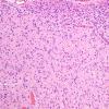 3B8 Oligodendroglioma (Case 3) H&E 10