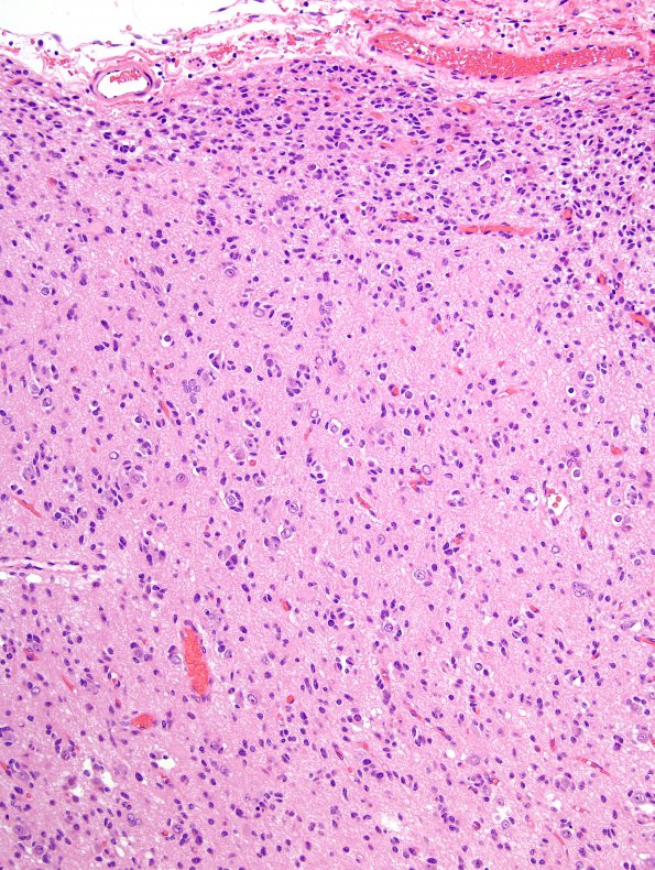 3B8 Oligodendroglioma (Case 3) H&E 10