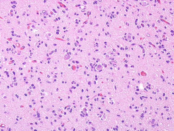 3B9 Oligodendroglioma (Case 3) H&E 11