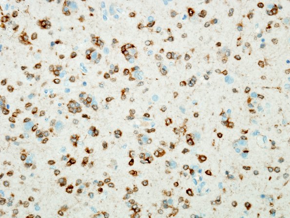 3C2 Oligodendroglioma (Case 3) IDH1 3