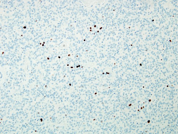 3D Oligodendroglioma (Case 3) MIB