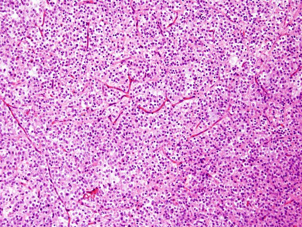 4A1 Oligodendroglioma (WHO-Grade 2,Case 4) H&E 1