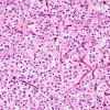 4A2 Oligodendroglioma (WHO-Grade 2, Case 4) H&E 4