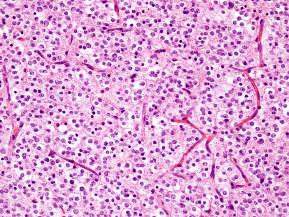 4A2 Oligodendroglioma (WHO-Grade 2, Case 4) H&E 4