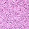 4A3 Oligodendroglioma (WHO-Grade 2, Case 4) H&E 5