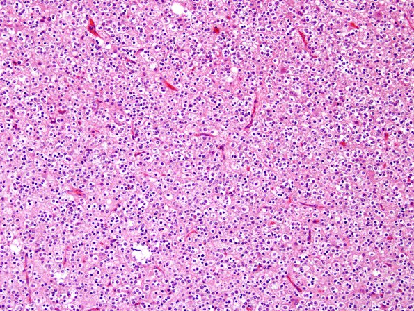 4A3 Oligodendroglioma (WHO-Grade 2, Case 4) H&E 5