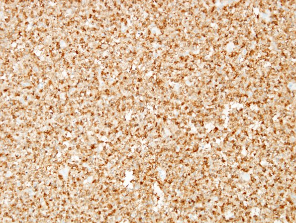 4B1 Oligodendroglioma (WHO-Grade 2, Case 4) IDH1 (fried egg area) 1