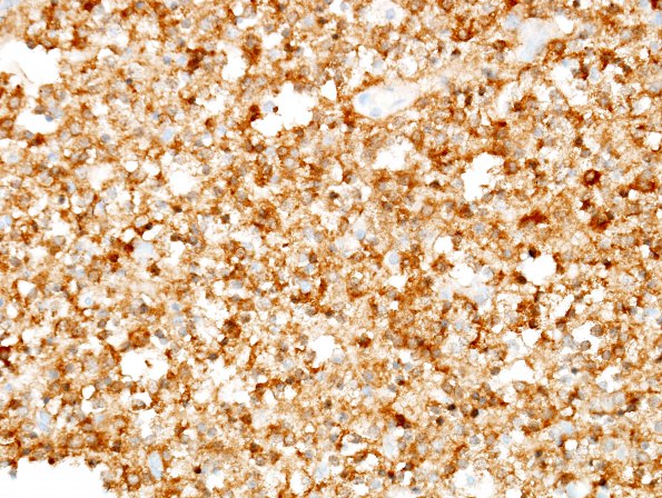 4B2 Oligodendroglioma (WHO-Grade 2, Case 4) IDH1 (fried egg area) 2