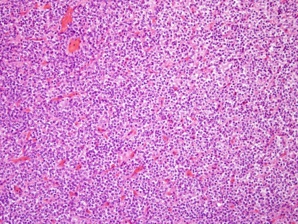 5A1 Oligodendroglioma, WHO 2 (Case 5) H&E.jpg