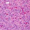 5A2 Oligodendroglioma, WHO 2 (Case 5) H&E 1.jpg