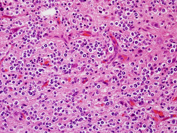 5A2 Oligodendroglioma, WHO 2 (Case 5) H&E 1.jpg