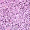 5A3 Oligodendroglioma, WHO 2 (Case 5) H&E 4.jpg