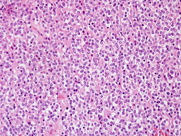 5A3 Oligodendroglioma, WHO 2 (Case 5) H&E 4.jpg