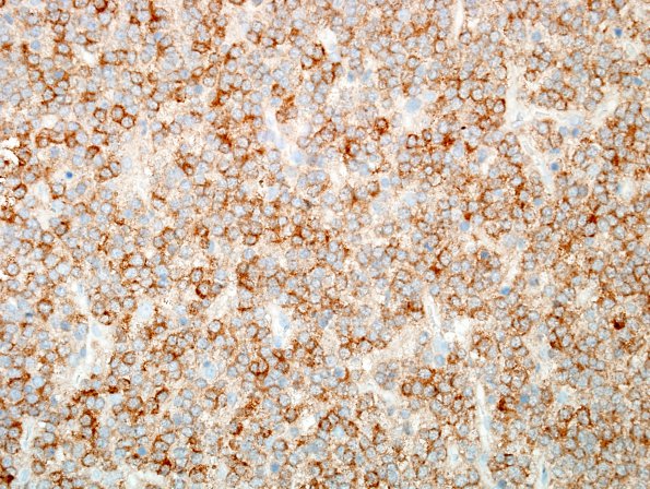 5B Oligodendroglioma, WHO 2 (Case 5) IDH1 (pR132H) 3.jpg