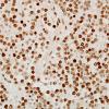 5C2 Oligodendroglioma, WHO 2 (Case 5) ATRX 12.jpg