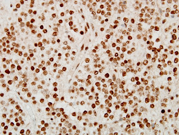 5C2 Oligodendroglioma, WHO 2 (Case 5) ATRX 12.jpg