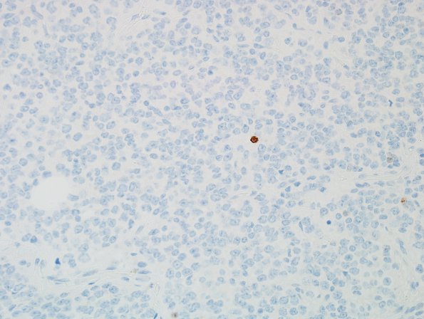 5D Oligodendroglioma, WHO 2 (Case 5) Ki67 2.jpg