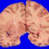 6 Oligodendroglioma, WHO II (Case 6)