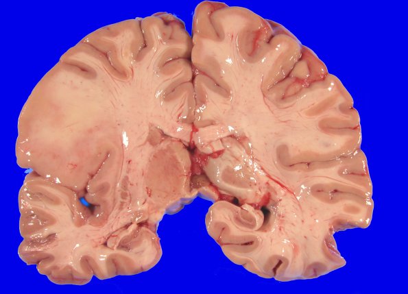 6 Oligodendroglioma, WHO II (Case 6)