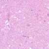 7A1 Oligodendroglioma & histiocytes, WHO Grade 2 (Case 7) H&E 9.jpg