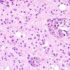 7A2 Oligodendroglioma & histiocytes, WHO II (Case 7) H&E 1.jpg