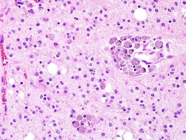 7A2 Oligodendroglioma & histiocytes, WHO II (Case 7) H&E 1.jpg