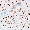 7B Oligodendroglioma & histiocytes, WHO II (Case 7) Olig2 1.jpg