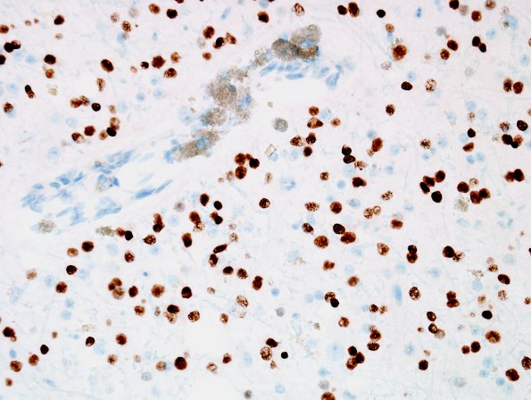 7B Oligodendroglioma & histiocytes, WHO II (Case 7) Olig2 1.jpg