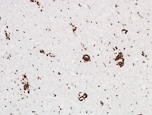 7C Oligodendroglioma & histiocytes, WHO II (Case 7) CD68 3.jpg