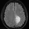 8A1 Oligodendroglioma WHO II (Case 8) FLAIR - Copy