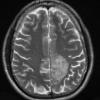 8A2 Oligodendroglioma WHO II (Case 8) T2 - Copy