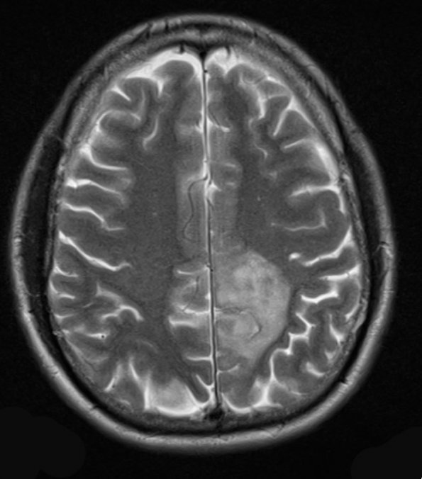 8A2 Oligodendroglioma WHO II (Case 8) T2 - Copy