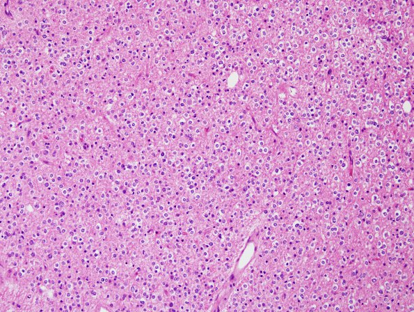 8B Oligodendroglioma WHO II (Case 8) H&E 3.jpg