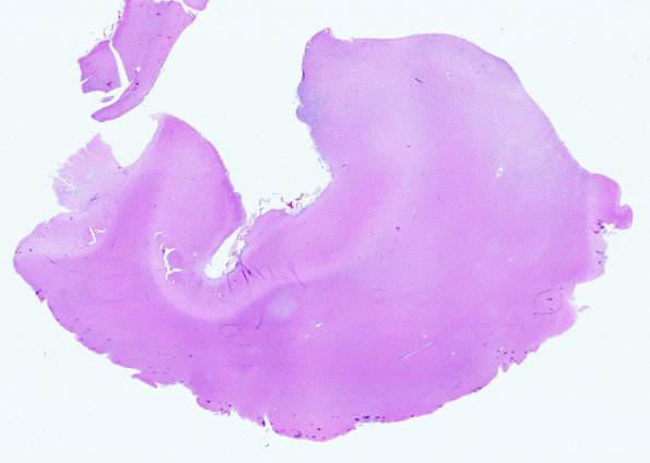 9A1 Oligodendroglioma Grade 2 (Case 9) A8 H&E WM