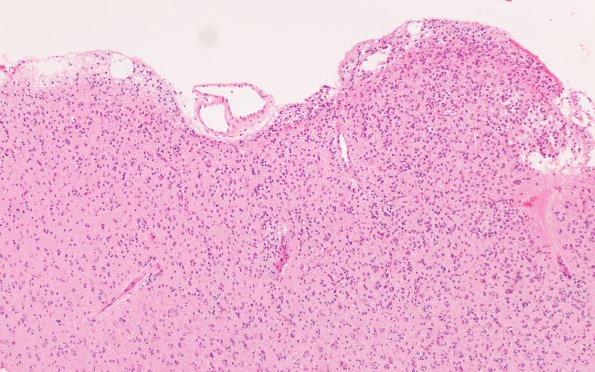 9A2 Oligodendroglioma Grade 2 (Case 9) A8 H&E 10X