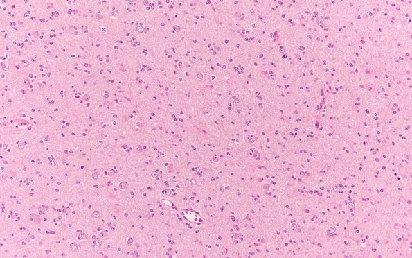 9A3 Oligodendroglioma Grade 2 (Case 9) A8 H&E 20X