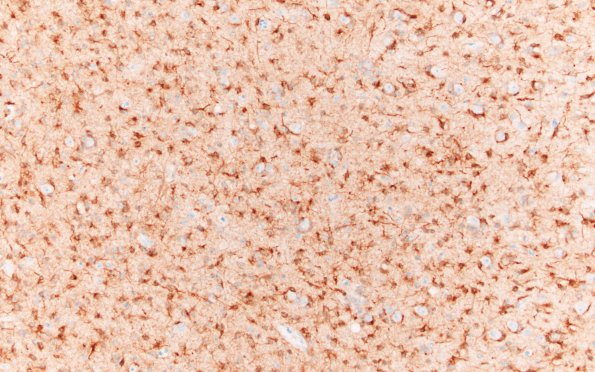 9B2 Oligodendroglioma Grade 2 (Case 9) A8 IDH1 20X