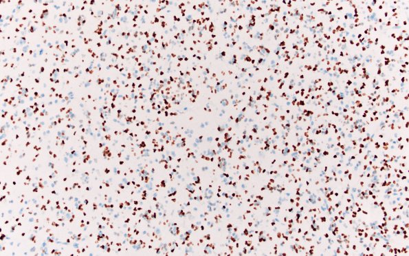 9C Oligodendroglioma Grade 2 (Case 9) A8 Olig2 20X