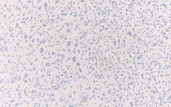 9E Oligodendroglioma Grade 2 (Case 9) A8 p53 20X