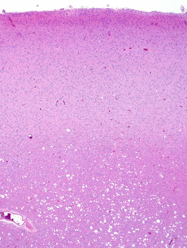 10A2 Oligodendroglioma, Grade III (Case 10) H&E 9