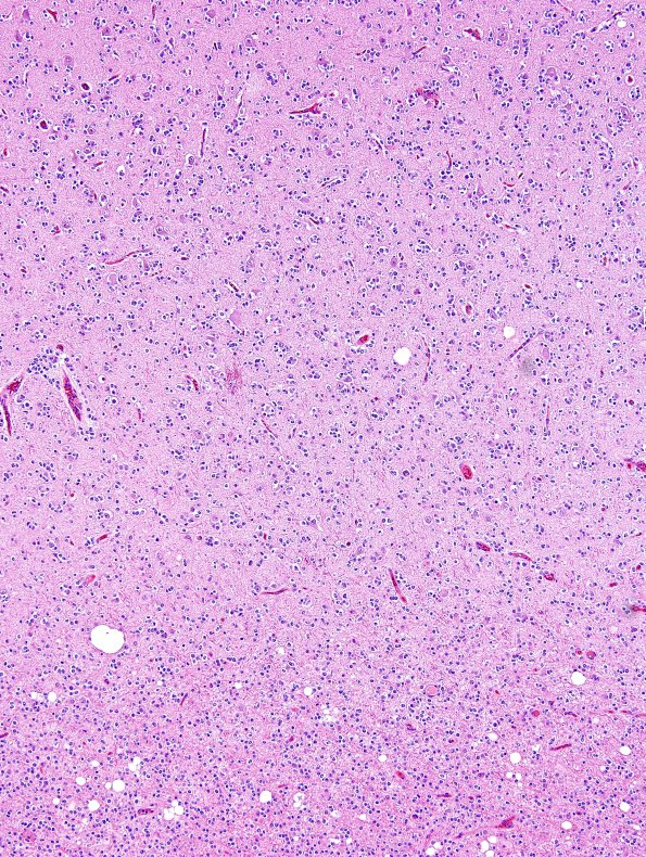 10A3 Oligodendroglioma, Grade III (Case 10) H&E 8