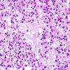 10A5 Oligodendroglioma, Grade III (Case 10) H&E 3