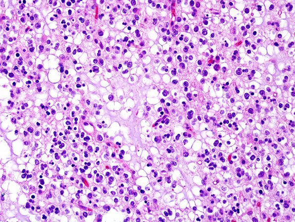 10A5 Oligodendroglioma, Grade III (Case 10) H&E 3