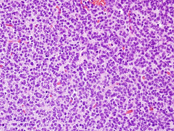 10A6 Oligodendroglioma, Grade III (Case 10) H&E 4