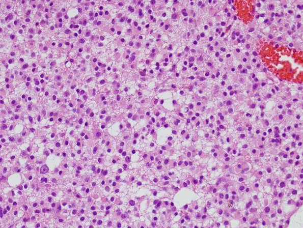 10A7 Oligodendroglioma, Grade 2 (Case 10) H&E 2