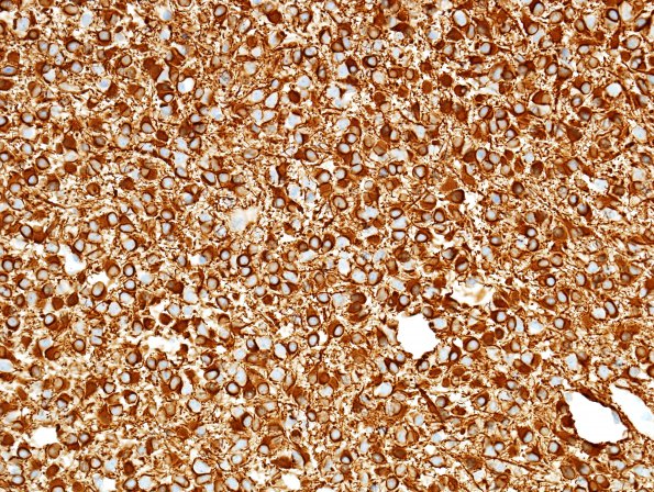 10B1 Oligodendroglioma, Grade 2 (Case 10) GFAP 1