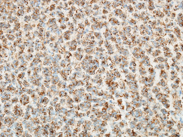 10B2 Oligodendroglioma, Grade III (Case 10) GFAP 7