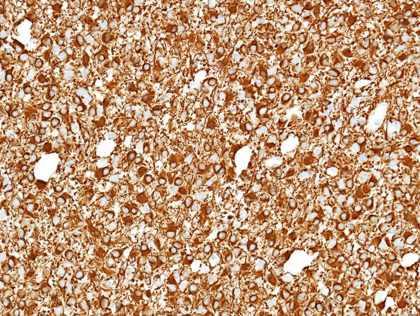 10B3 Oligodendroglioma, Grade 2 (Case 10) GFAP 2