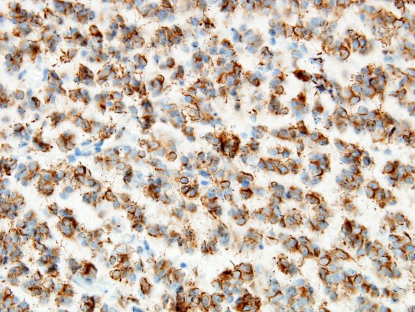 10B4 Oligodendroglioma, Grade III (Case 10) GFAP 1