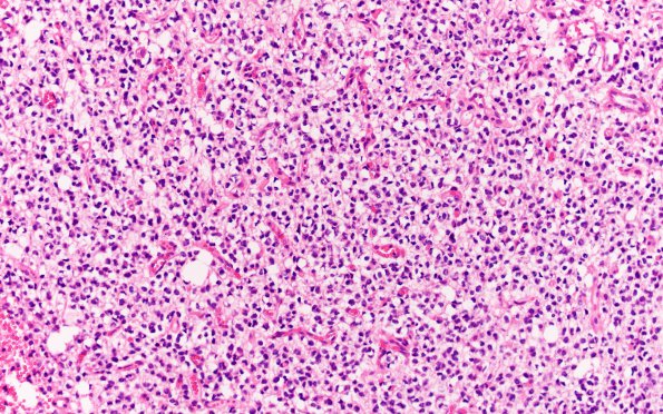 11A Oligodendroglioma, anaplastic (Case 11) H&E 1